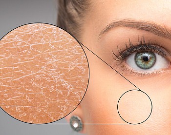 What is microdermabrasion?