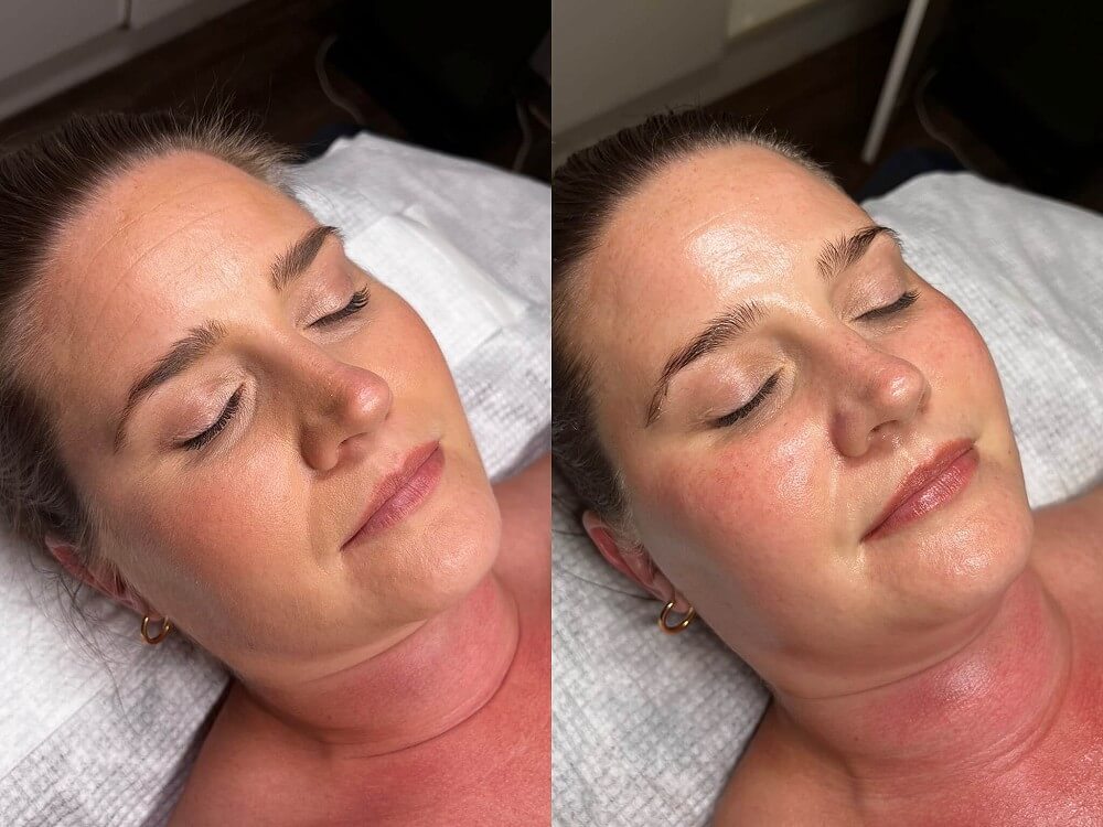 Glass Skin Treatment Explained