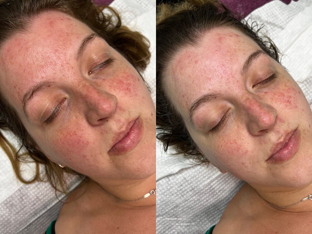 Omega Green PDT Treatment Explained